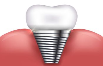 Simgle Dental Implant